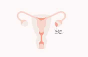 ¿Por qué se producen los quistes en los ovarios?