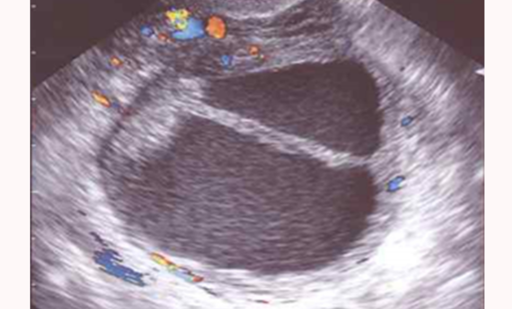 ¿Por qué se producen los quistes en los ovarios? Ginemed