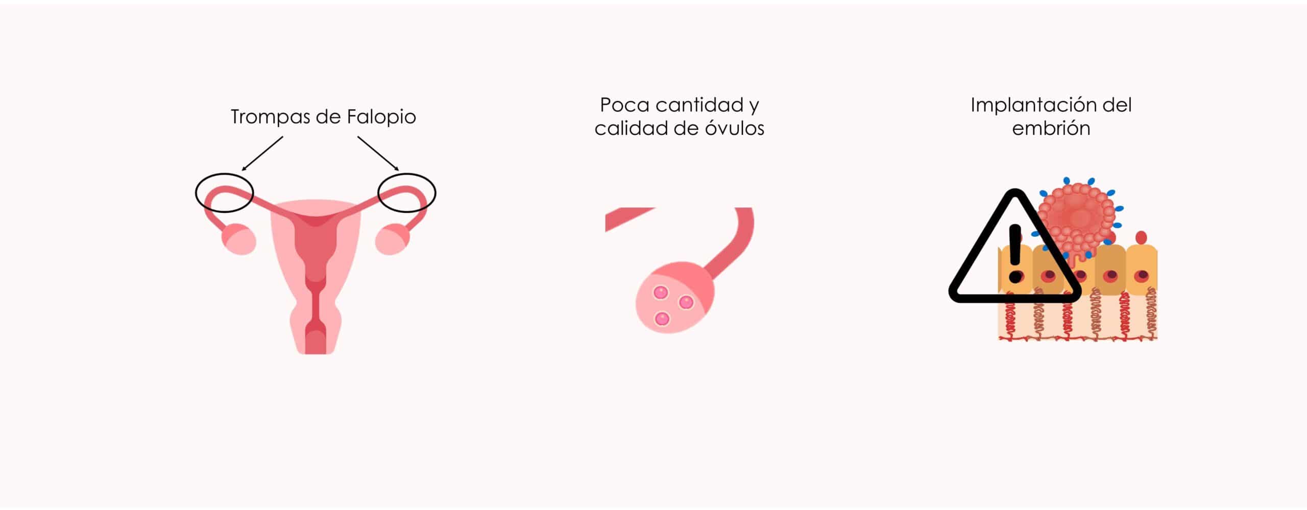 ¿Qué consecuencias tiene la endometriosis en la fertilidad femenina?