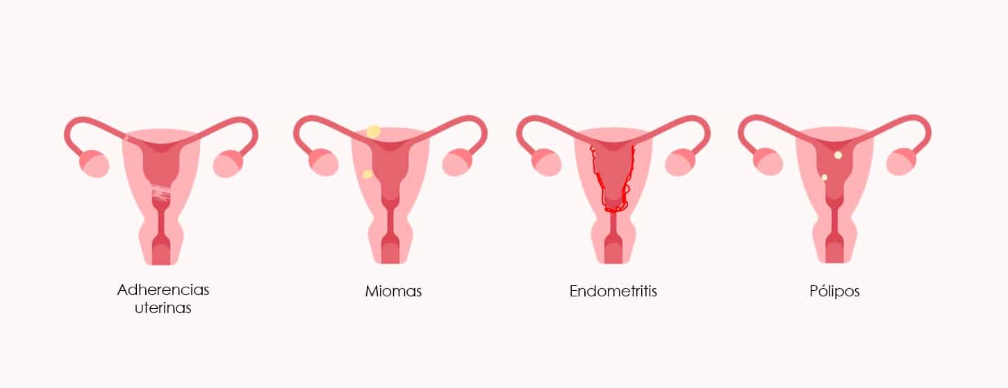 Patologías uterinas que pueden afectar la fertilidad femenina
