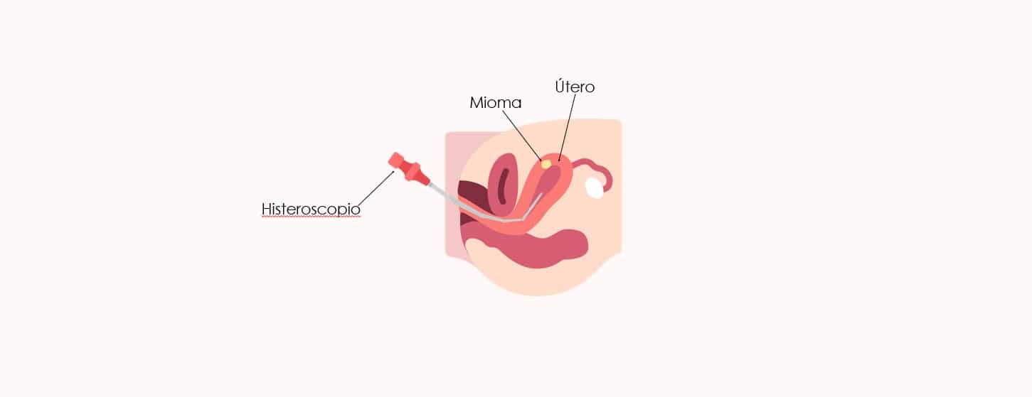 Histeroscopia para eliminar patologías uterinas