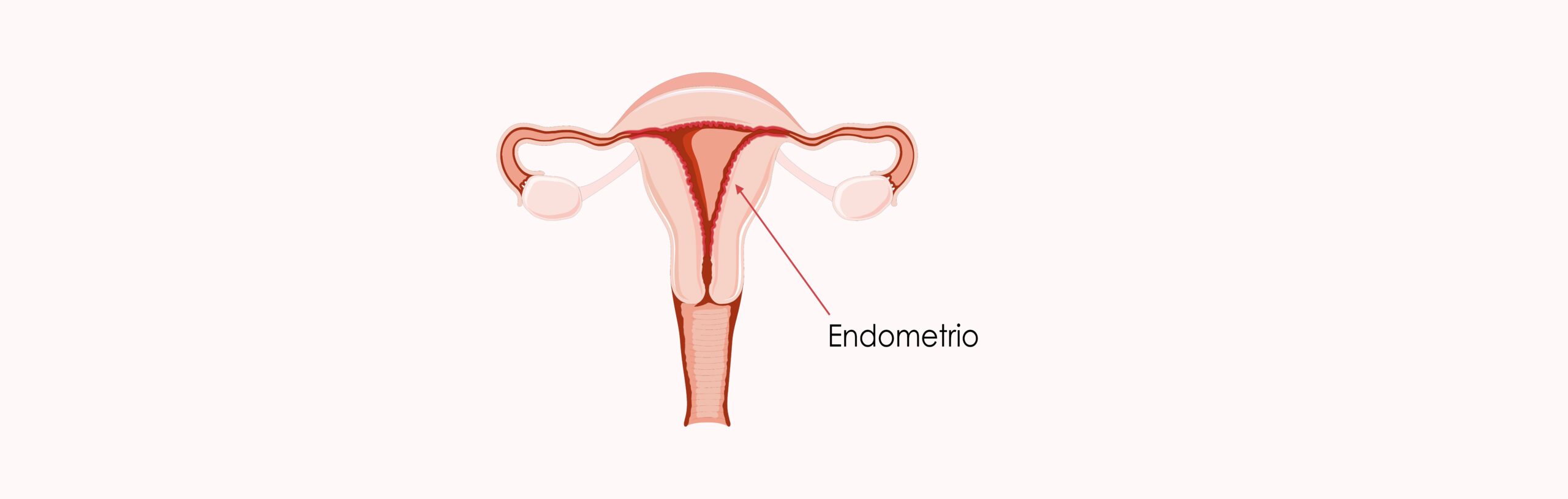 ¿Cuándo hacer una biopsia endometrio?