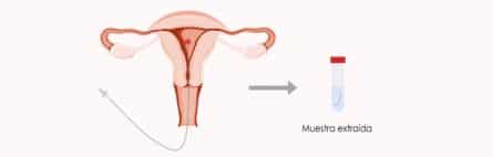 ¿Qué es una biopsia de endometrio?