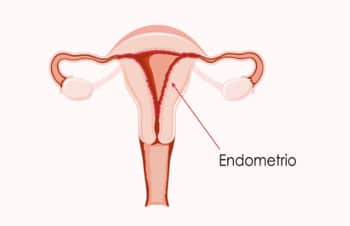 ¿Por qué hacer una biopsia de endometrio?