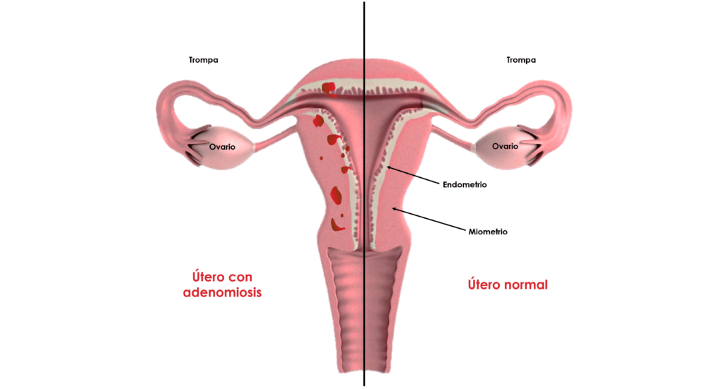 Útero con ademoniosis comparado con un útero normal