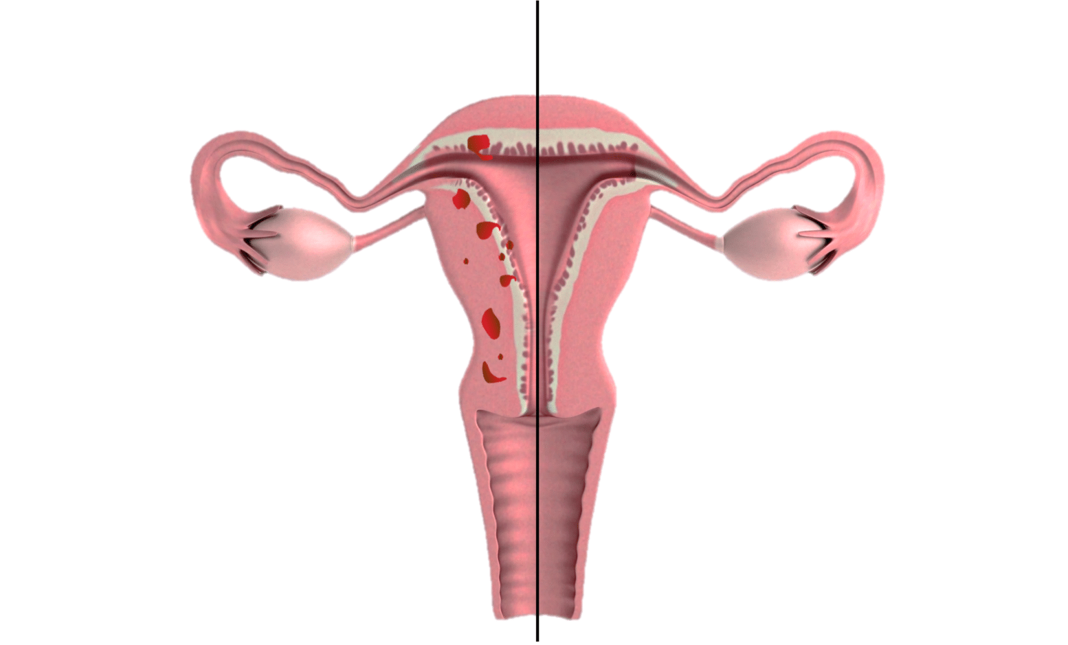 Utero adenomiosis Utero normal sin nombres