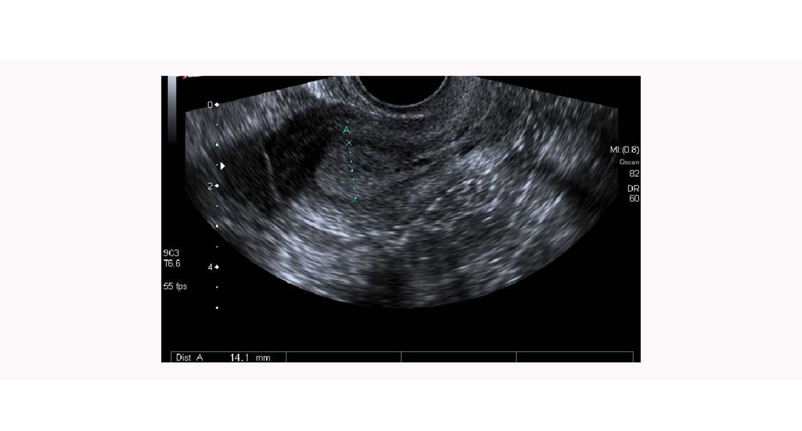 endometrio en implantación