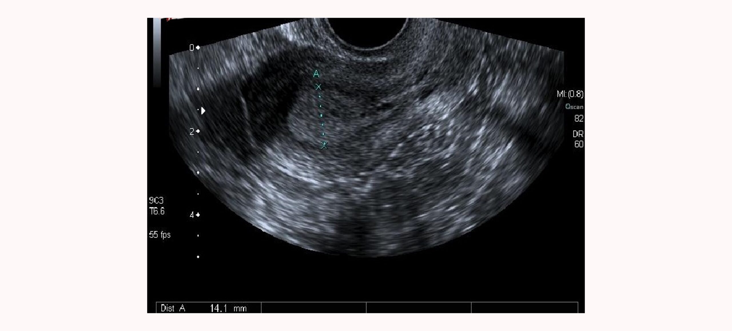 Con la ecografía podemos observar la receptividad endometrial