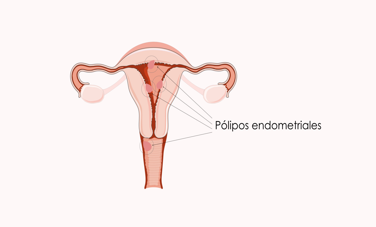 ¿Qué es un pólipo endometrial?