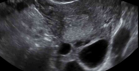 baja-reserva-ovarica-probabilidad-embarazo