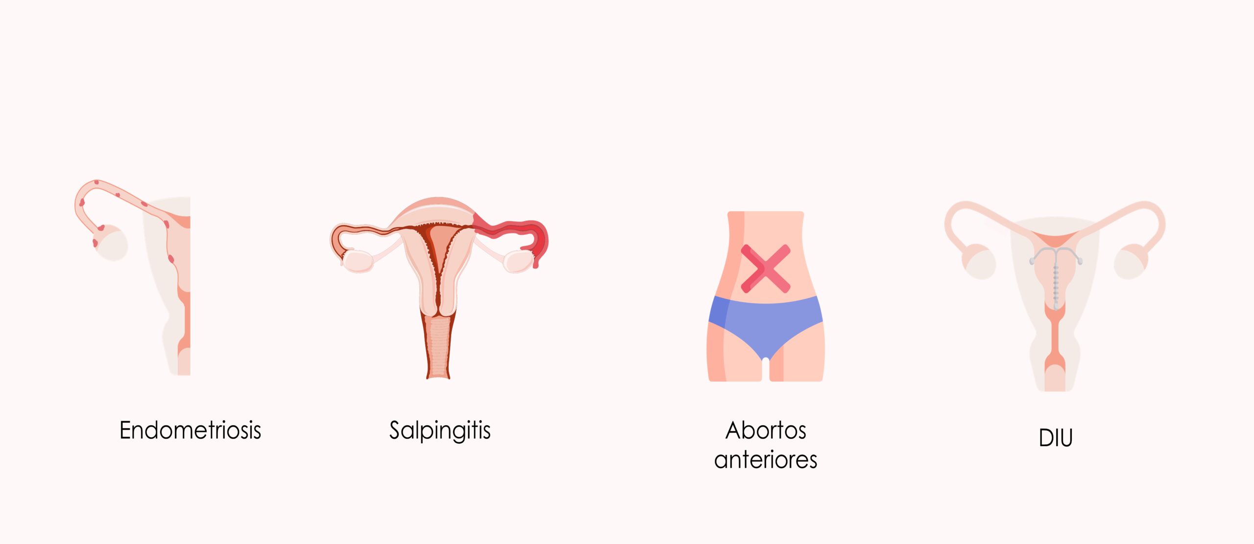 posible-embarazo-obstrucción-trompas