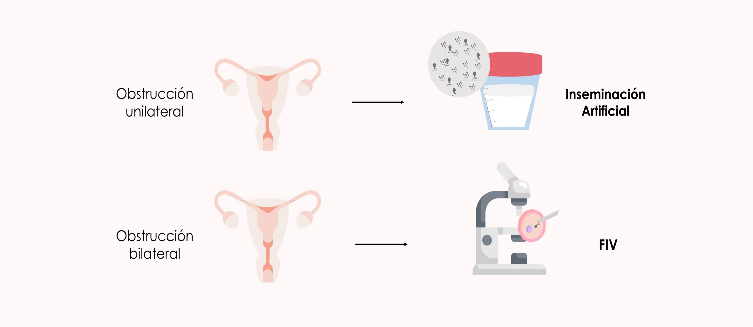 posible-embarazo-obstrucción-trompas
