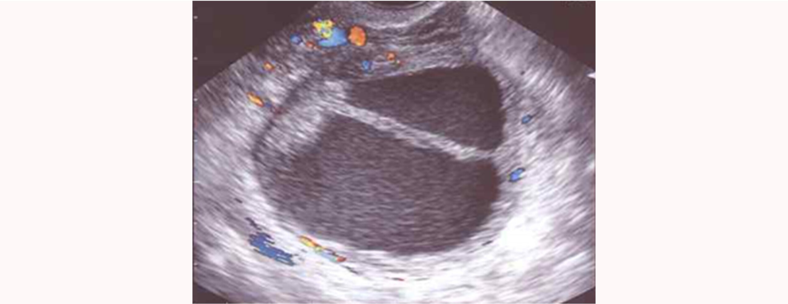Imagen real de útero con endometriosis