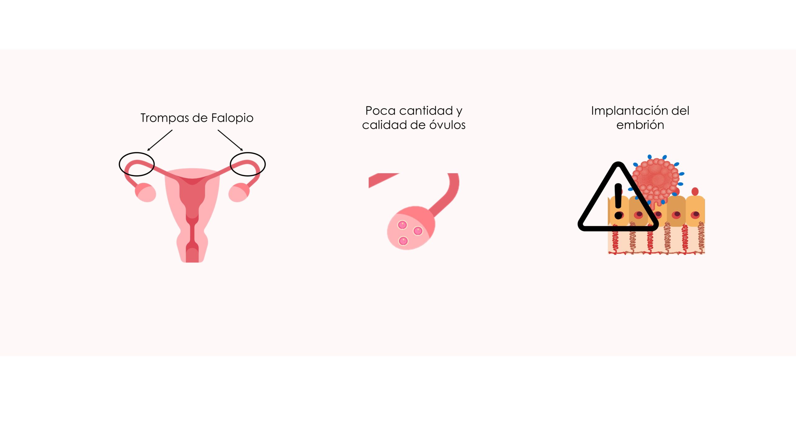 La endometriosis se asocia a la infertilidad por varios factores: alteración de las trompas, de la reserva ovárica y de la implantación uterina