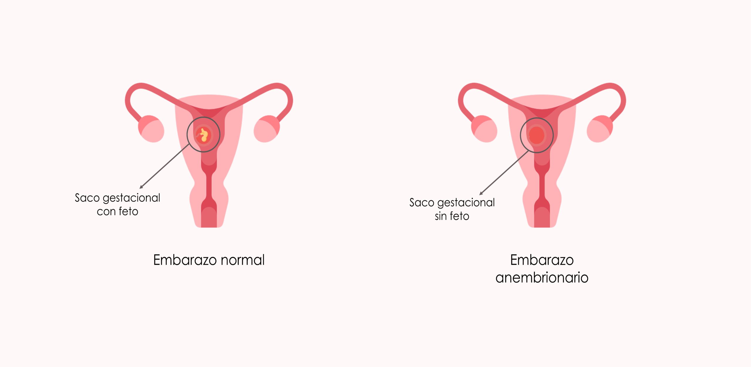 Diferencia entre embarazo normal y embarazo anembrionario