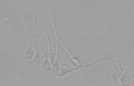 embarazo y escasa concentración de esperma