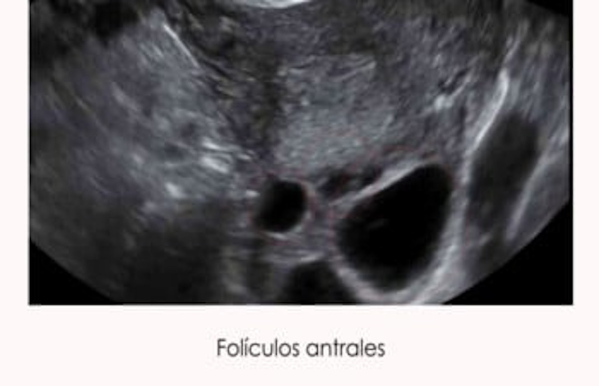 Forículos antrales