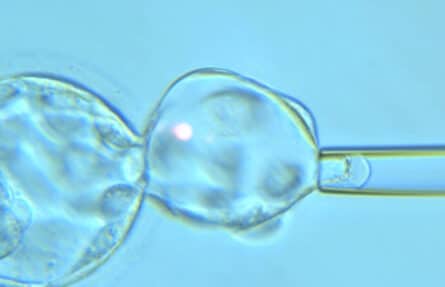 El PGT permite transferir embriones no afectos de hemofilia al útero materno