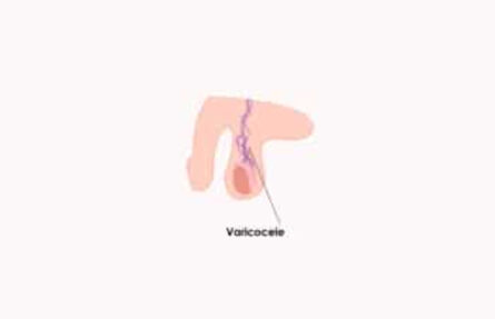 ¿Cómo mejorar la fragmentación espermática causada por el varicocele?