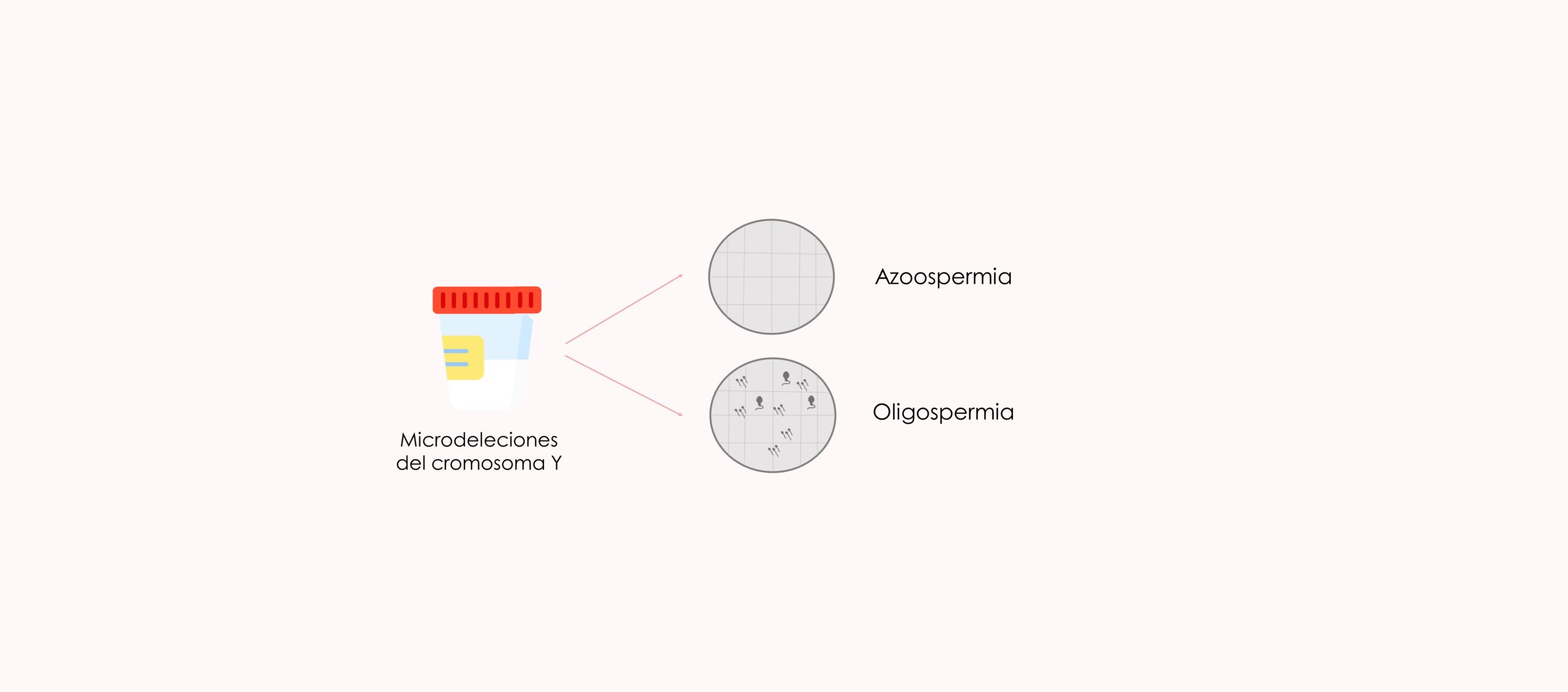 ¿Cómo se diagnostican las microdeleciones en en cromosoma Y?