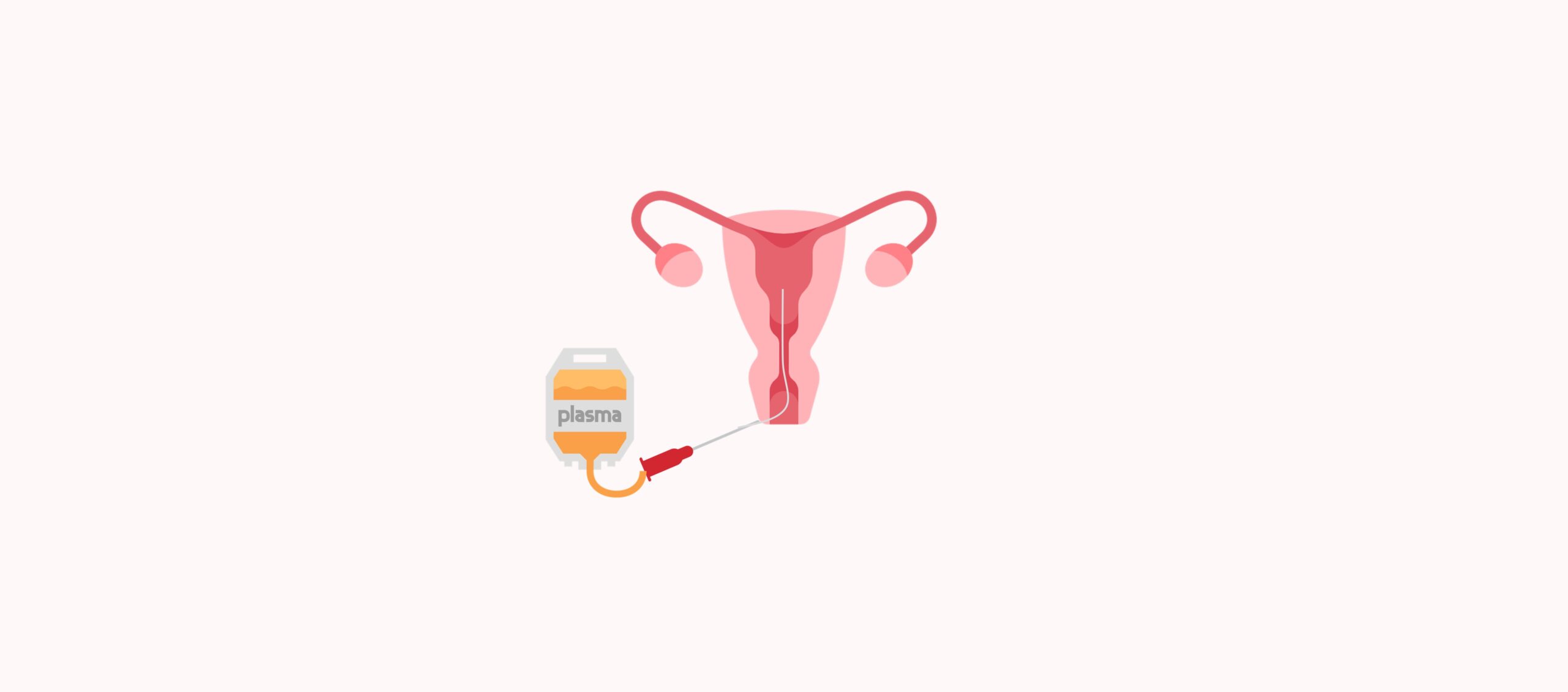 Cómo se aplica el PRP para mejorar la receptividad endometrial