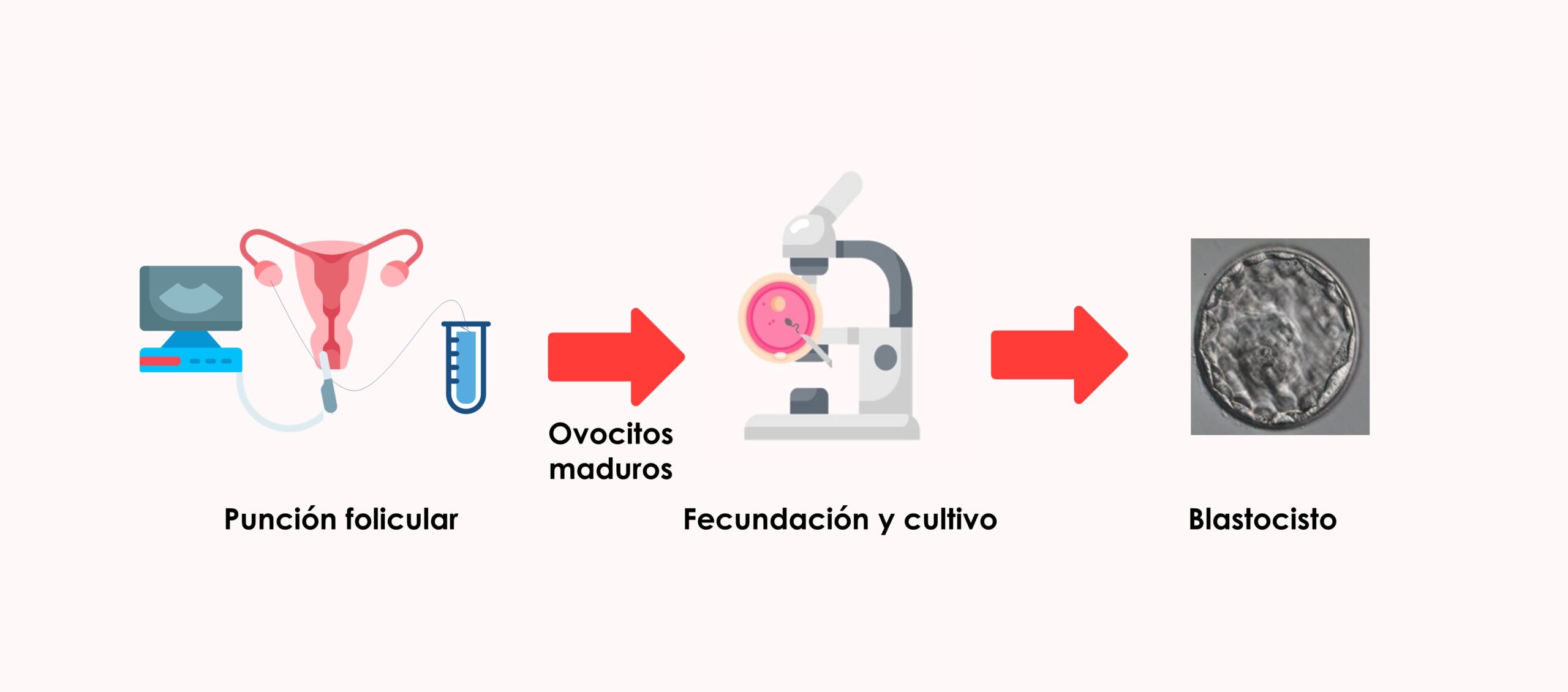 El número de ovocitos obtenidos en punción ovárica no suele corresponderse con el número de embriones disponibles para transferencia embrionaria