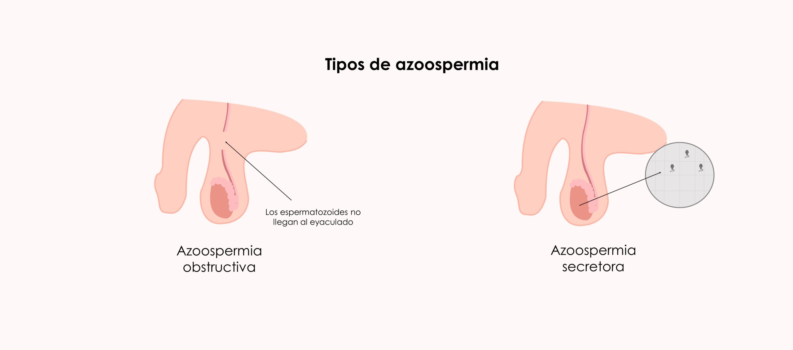 Tipos de azoospermia