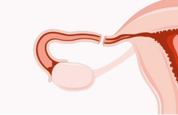 Posibilidades de embarazo tras la ligadura de trompas