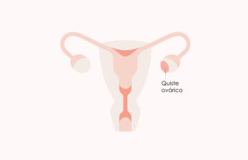 ¿Afectan los quistes a la fertilidad? ¿Es posible un embarazo natural?