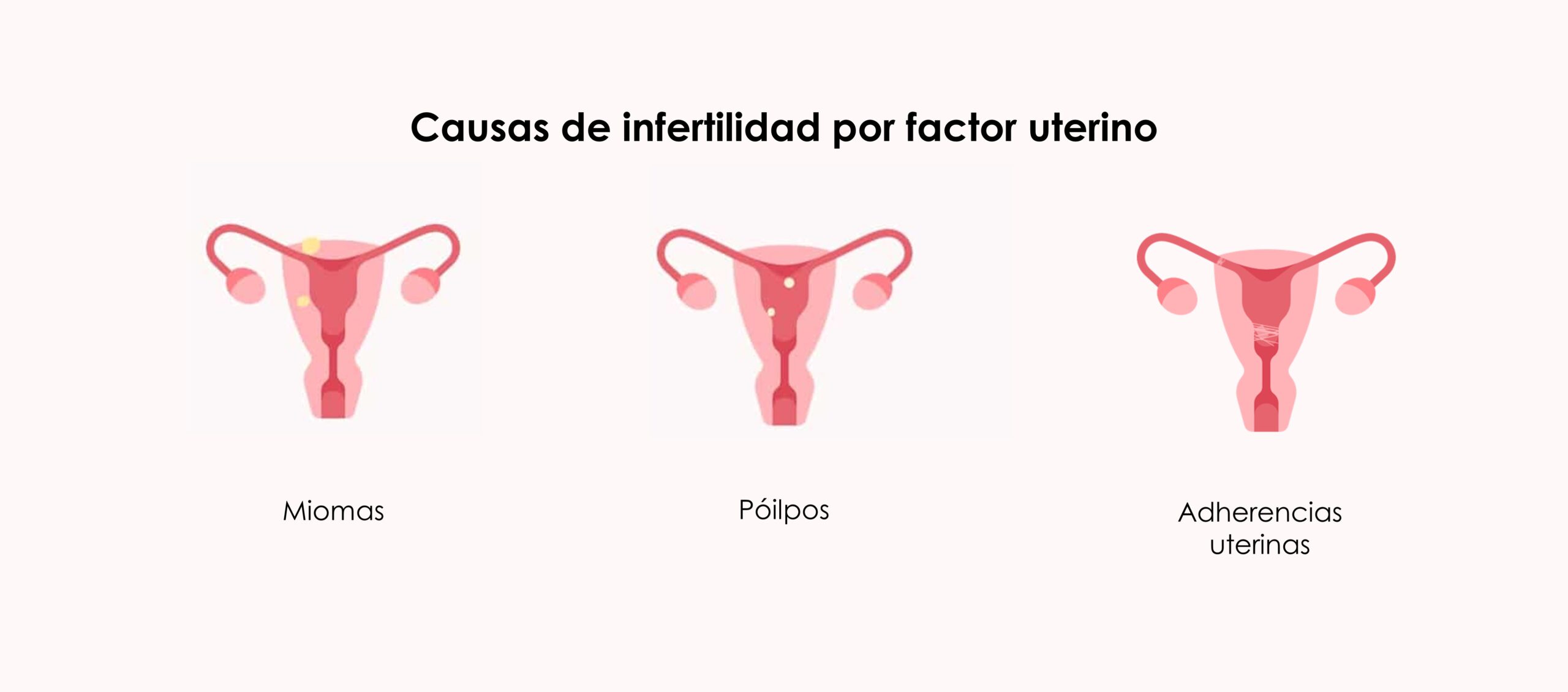 Causas de la infertilidad por factor uterino
