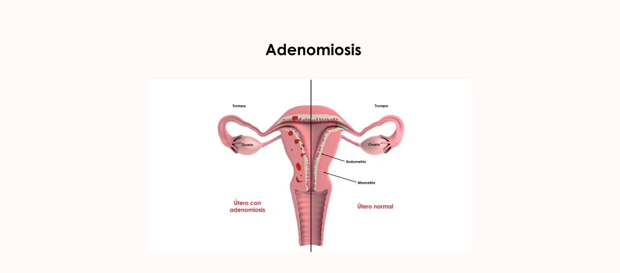 La adenomiosis, otra posible causa de infertilidad por factor uterino