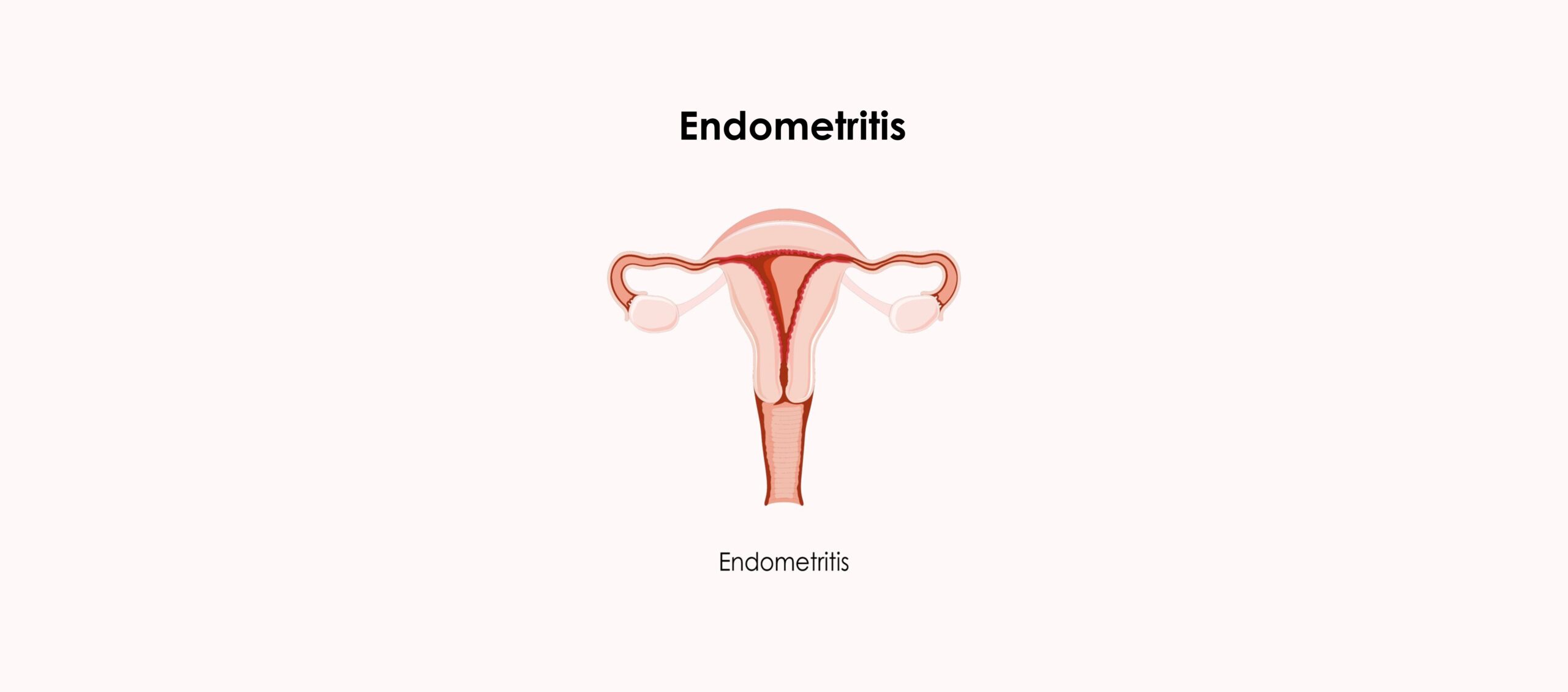 Endometritis, causa de infertilidad por factor uterino