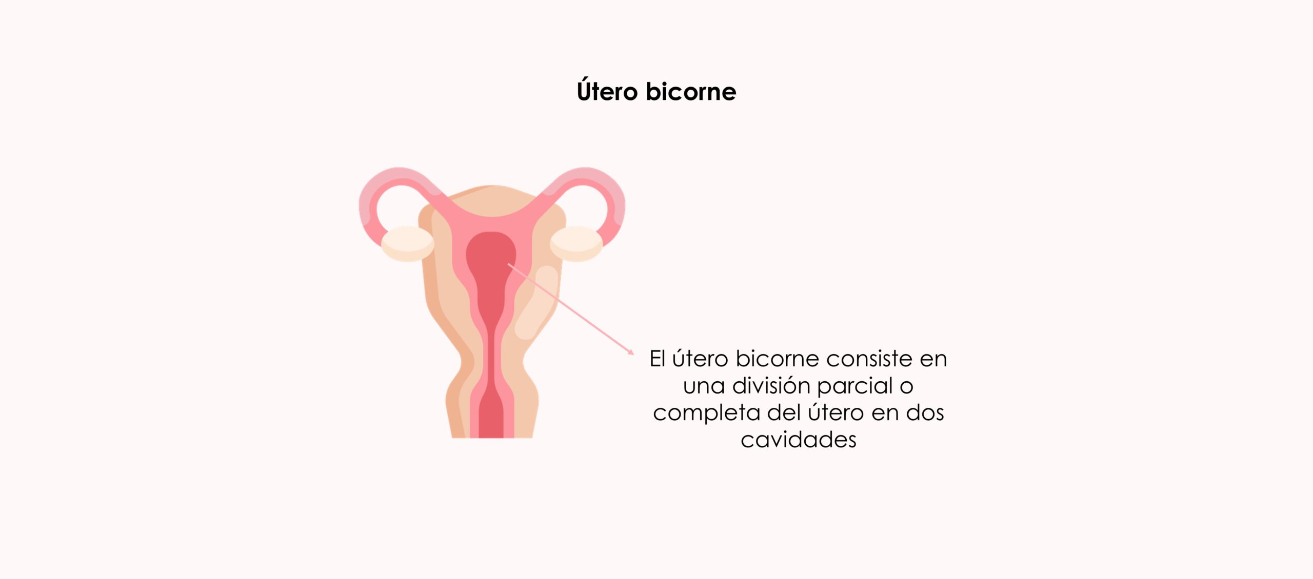 Útero bicorne, qué es y cómo influye en la fertilidad