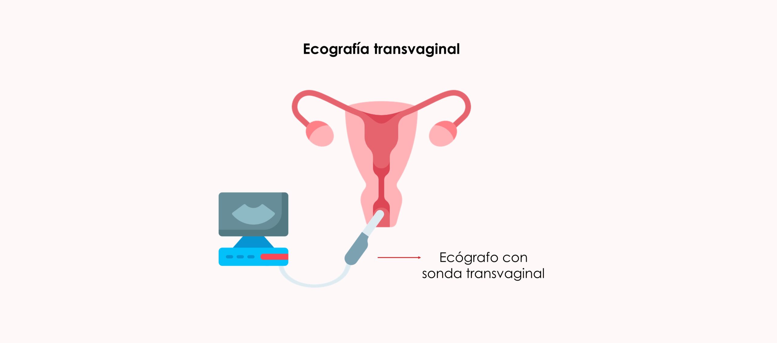 Ecografía transvaginal